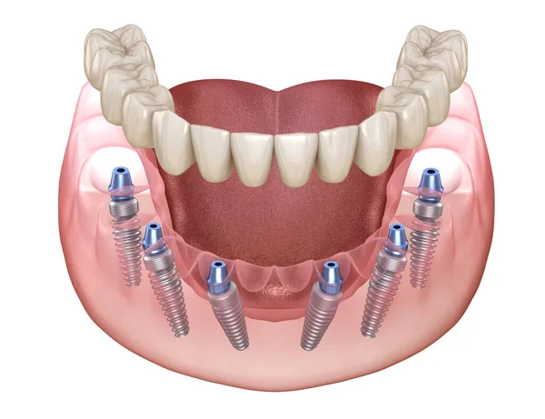 Çene Protezi Hepsi Implantlarla Desteklenen Sistemde Nsan Dişleri Protez Kavramının — Stok fotoğraf