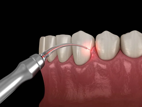 Gum correction surgery with laser.  Medically accurate tooth 3D illustration