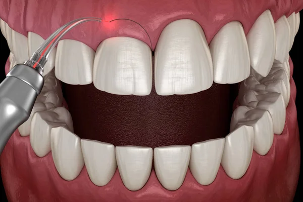 Gingivectomy surgery with laser using.  Medically accurate tooth 3D illustration
