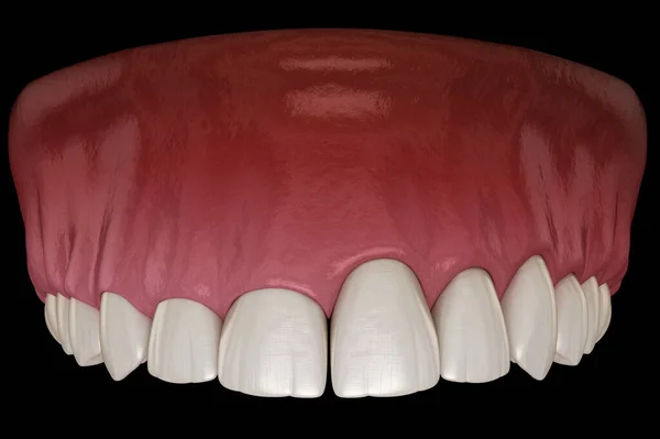 Chirurgia Della Gengivectomia Con Laser Illustrazione Del Dente Clinicamente Accurata — Foto Stock