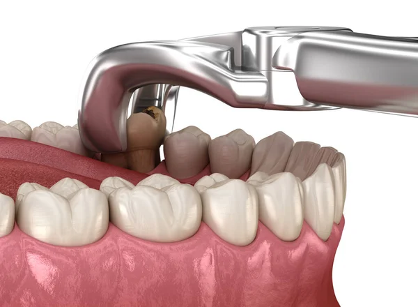 Azı Dişinin Alınması Bakteriler Tarafından Zarar Görmüş Tıbbi Olarak Doğru — Stok fotoğraf