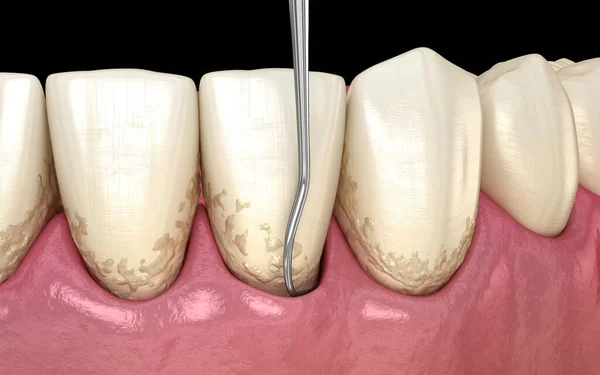 Munhygien Skalning Och Rothyvling Konventionell Parodontal Behandling Medicinskt Korrekt Illustration — Stockfoto