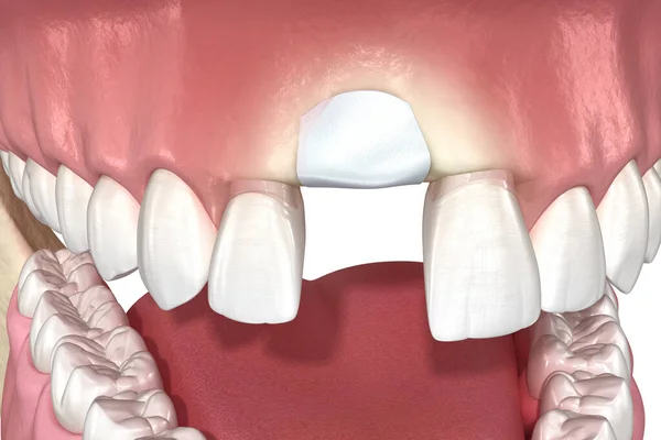 拡張外科 歯の抽出後に骨を追加します 3Dイラスト — ストック写真