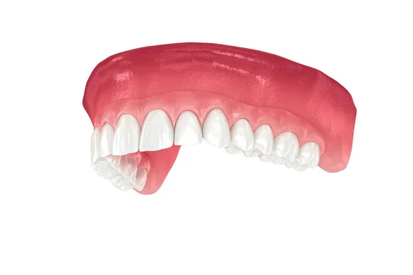 Prótese Maxilar Apoiada Por Dentes Implantes Ilustração Medicamente Precisa — Fotografia de Stock