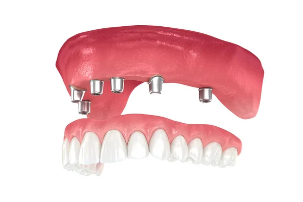 Максимальный Протез Поддерживаемый Зубами Имплантатами Медицинская Точность Иллюстрации — стоковое фото