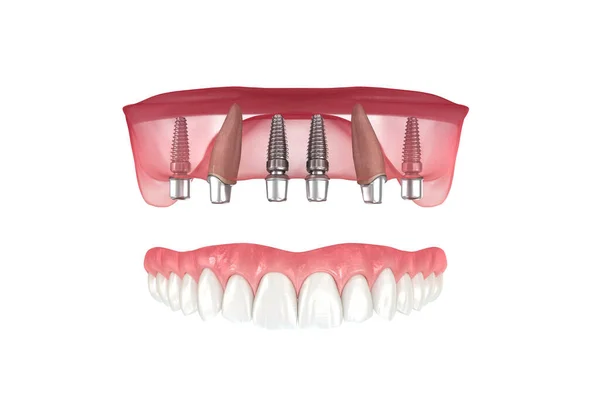 Prótese Maxilar Apoiada Por Dentes Implantes Ilustração Medicamente Precisa — Fotografia de Stock