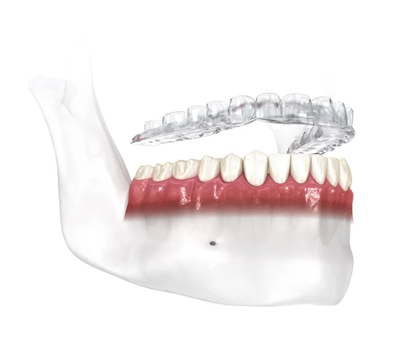 Morso Splint Protezione Bruxismo Illustrazione Dentale Clinicamente Accurata — Foto Stock
