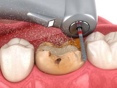 Caries çıkarma işlemi. Diş 3B illüstrasyon