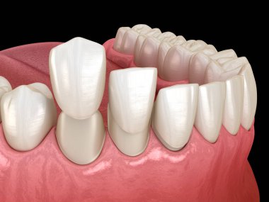 Diş kaplaması yerleştirme prosedürü. Diş 3B illüstrasyon