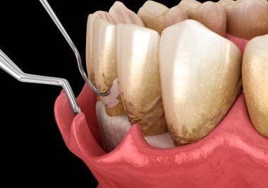 Açık curettage: Ölçekleme ve kök planlama (geleneksel periodontal terapi). Diş 3B illüstrasyon