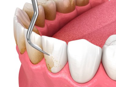 Ağız temizliği: Ölçekleme ve kök planlama (geleneksel periodontal terapi). Diş 3B illüstrasyon