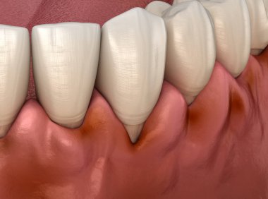 Diş etlerinde diş eti iltihabı. Diş 3B illüstrasyon