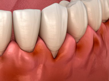 Gingivitis inflammation of the gums. Dental 3D illustration clipart