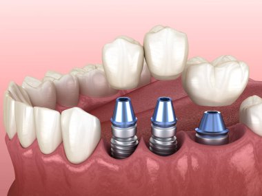 3 implantın üzerine 3 diş yerleştirme - kavram. Diş 3B illüstrasyon