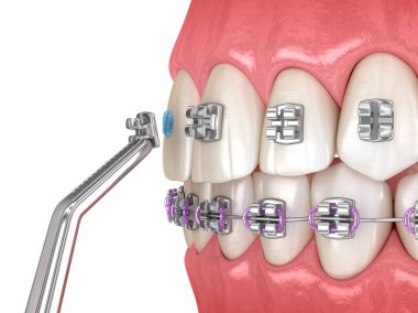 Metal parantez kurulum süreci. Diş 3B illüstrasyon