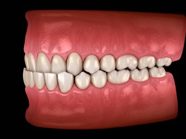 Diş altı tıkanıklığı (dişlerin Maloklüzyonu). Diş 3B illüstrasyon