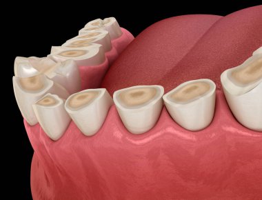 Dental attrition (Bruxism) resulting in loss of tooth tissue. Dental 3D illustration clipart