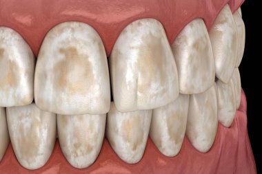 Diş mineralizasyonu, sert dokulardan minerallerin çıkarılması: diş minesi, dentin ve cementu. Diş 3B illüstrasyon