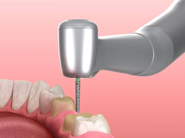 Prämolare Präparation Für Die Platzierung Der Zahnkrone Zahnärztliche Illustration — Stockfoto