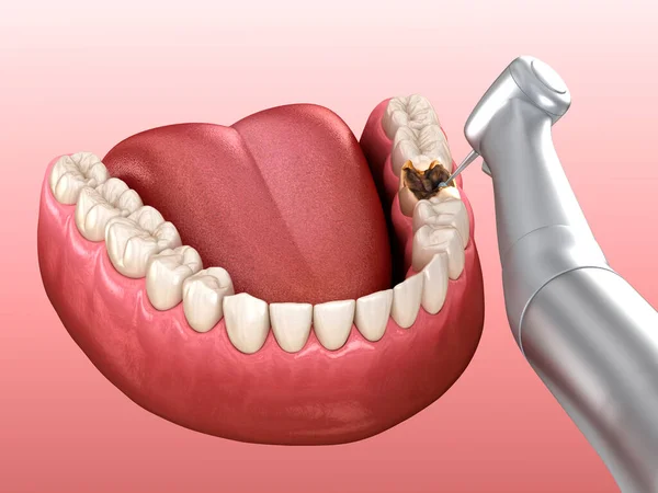 Caries removing process. Dental 3D illustration