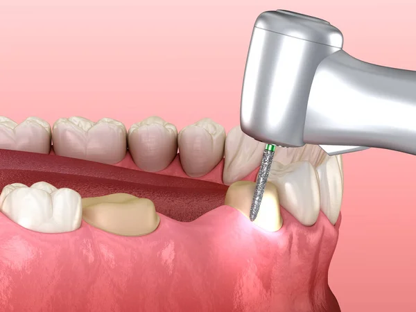 Processo Preparazione Premolare Posizionamento Della Corona Dentale Illustrazione Dentale — Foto Stock