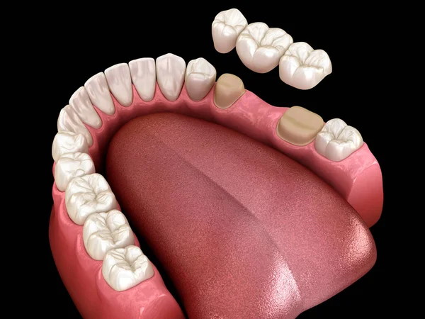 磨牙和前磨牙上有3颗牙齿的牙桥 牙科3D图解 — 图库照片