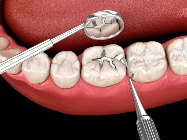 Restauração Dentária Deteriorada Com Enchimento Composto Ilustração Dental — Fotografia de Stock