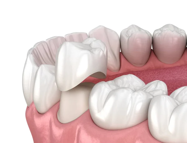 Voorbereide Premolaire Tand Tandheelkundige Kroon Plaatsing Tandheelkundige Illustratie — Stockfoto