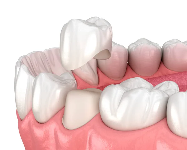 Voorbereide Premolaire Tand Tandheelkundige Kroon Plaatsing Tandheelkundige Illustratie — Stockfoto
