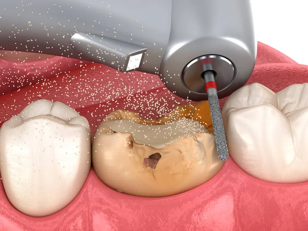 Caries removing process. Dental 3D illustration