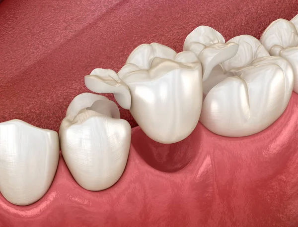 Меріленд Міст Зроблений Керамічного Премолярного Відновлення Зубів Dental Illustration — стокове фото