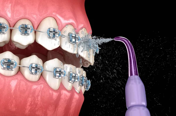 Irrigator, Water teeth cleaning. Dental 3D illustration of oral hygiene.