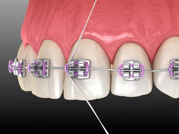 Processo Limpeza Aparelho Dental Fio Dental Ilustração Odontológica Higiene Oral — Fotografia de Stock