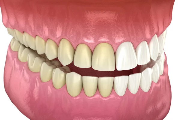 Bělení Zubů Před Zubní Ilustrace — Stock fotografie