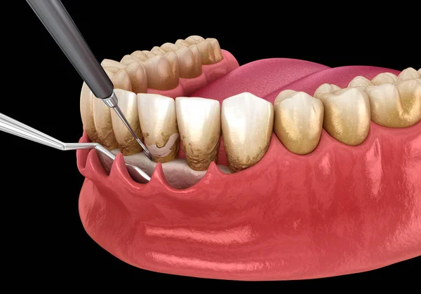 スケーリングと根計画 従来の歯周病治療 歯科用3Dイラスト — ストック写真