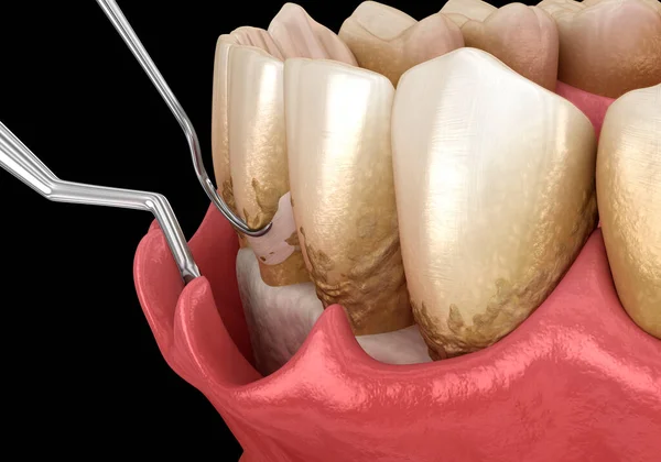鳞片和根部修整 传统的牙周病治疗 牙科3D图解 — 图库照片