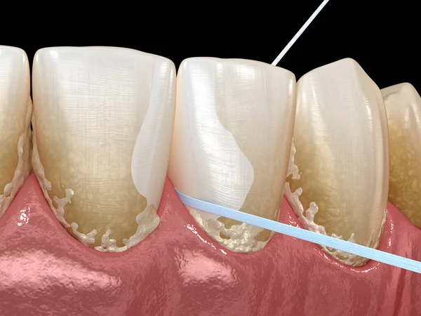 口腔衛生 歯垢除去のためのデンタルフロスを使用しています 歯科用3Dイラスト — ストック写真
