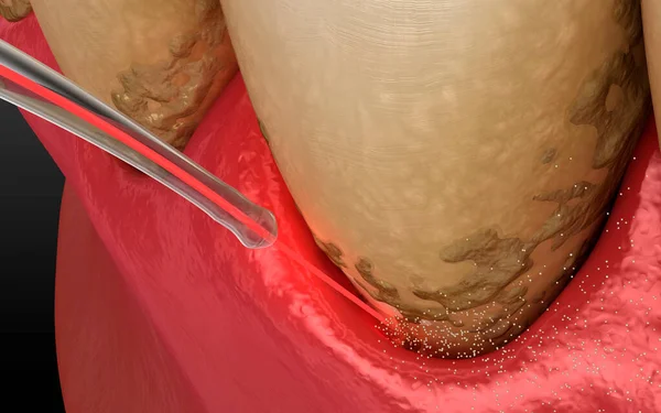 Laser Entfernt Zahnstein Und Dünne Schicht Der Infizierten Haut Zahnreinigung — Stockfoto