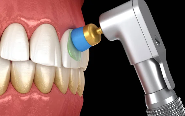Zahnpolierverfahren Mit Professioneller Bürste Und Gel Zahnärztliche Illustration — Stockfoto