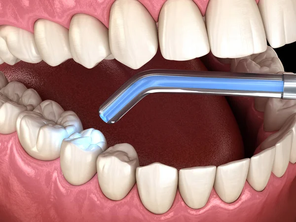充填および重合ランプで歯の復元 歯科用3Dイラスト — ストック写真