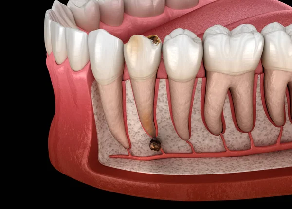 stock image Periostitis tooth - Lump on Gum Above Tooth. Dental dental 3D illustration