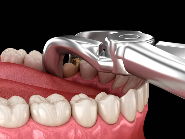 ケアによって損傷を受けたモル歯の抽出 歯科用3Dイラスト — ストック写真
