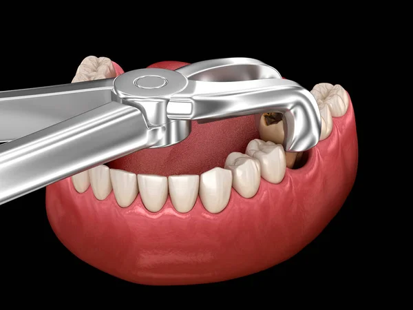 Удаление Зуба Поврежденного Кариесом Стоматологическая Иллюстрация — стоковое фото