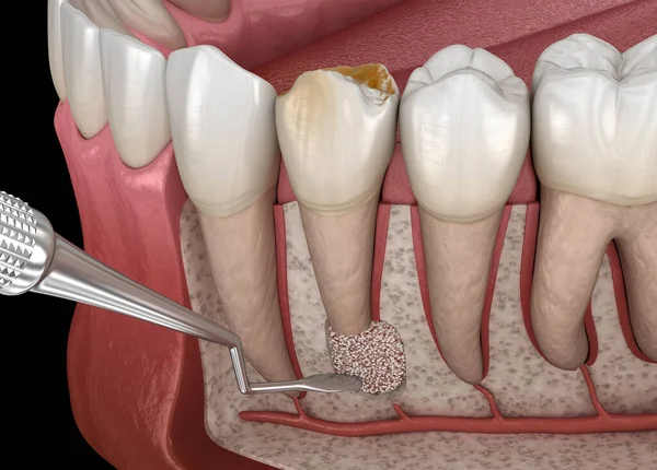 Cirurgia Cistectomia Dentária Recuperação Após Periostite Ilustração Dental — Fotografia de Stock