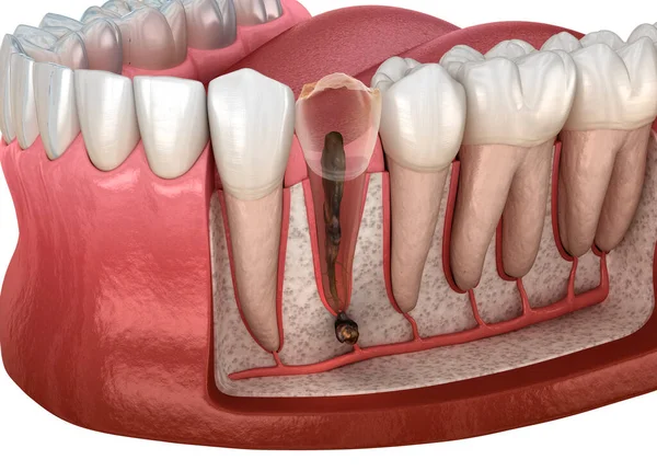 Zub Periostitidou Žvýkačka Nad Zubem Zubní Ilustrace — Stock fotografie