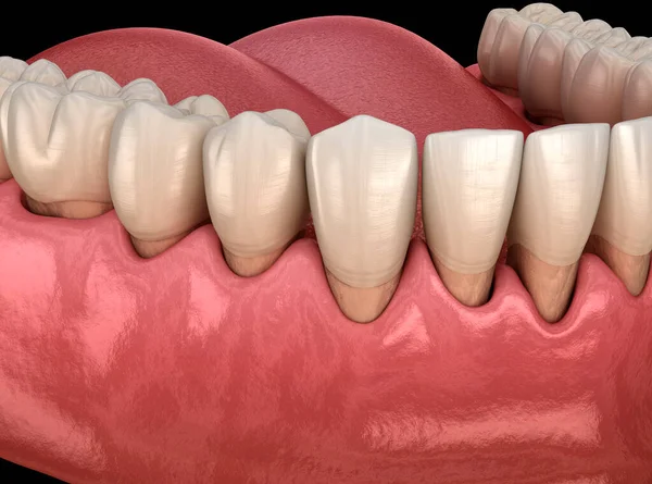 Diş Etlerinde Diş Eti Iltihabı Diş Illüstrasyon — Stok fotoğraf