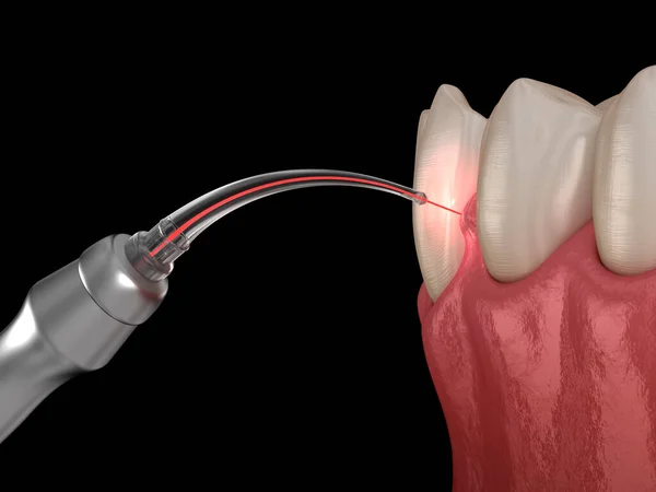 Gum correction surgery with laser.  Dental 3D illustration