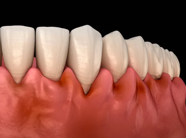 Gingivitis Inflamación Las Encías Ilustración Dental — Foto de Stock