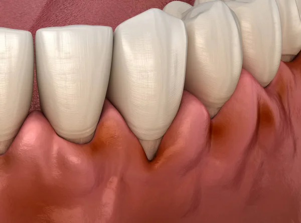 Φλεγμονή Ουλίτιδας Των Ούλων Οδοντιατρική Απεικόνιση — Φωτογραφία Αρχείου