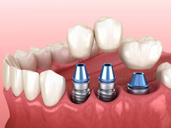 三个牙冠放置在三个植入物之上 牙科3D图解 — 图库照片